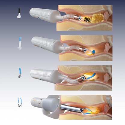 Wipear - Nettoyeur d’oreilles intelligent